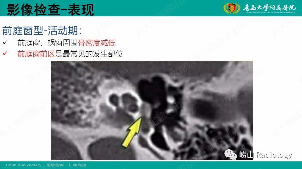 影像PPT - 【病例】耳硬化症1例CT影像-15