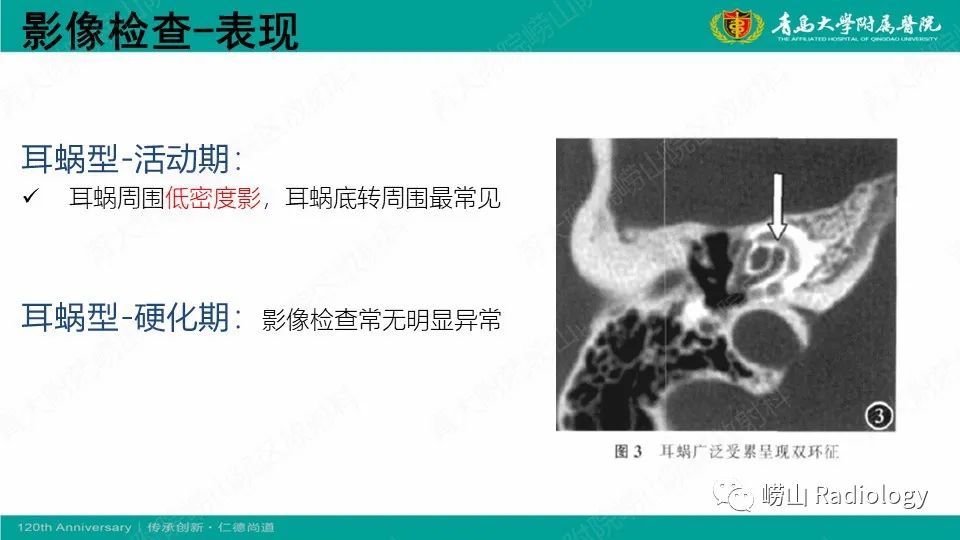 影像PPT - 【病例】耳硬化症1例CT影像-17