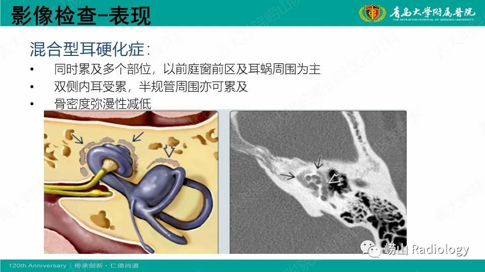 影像PPT - 【病例】耳硬化症1例CT影像-18