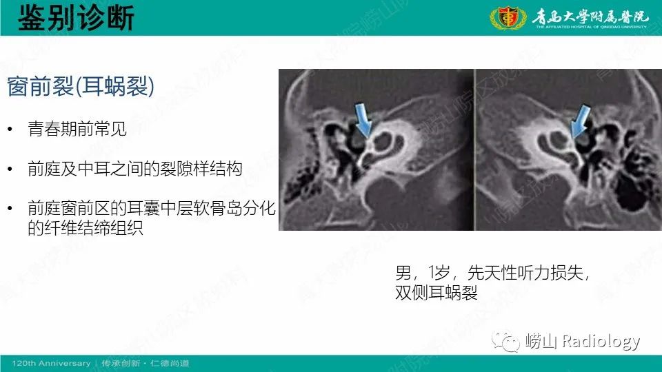 影像PPT - 【病例】耳硬化症1例CT影像-20