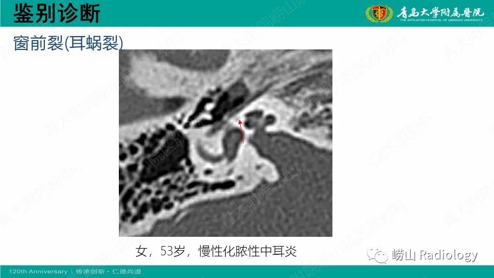 影像PPT - 【病例】耳硬化症1例CT影像-21