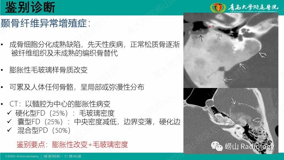 影像PPT - 【病例】耳硬化症1例CT影像-23
