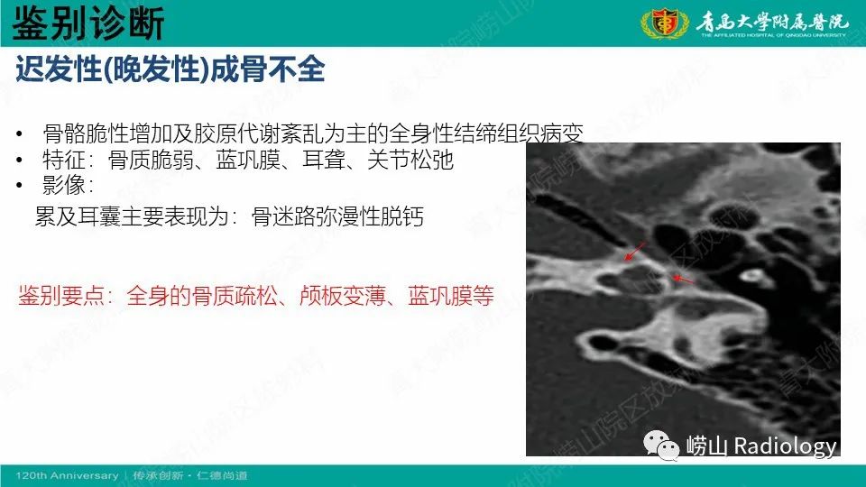 影像PPT - 【病例】耳硬化症1例CT影像-25