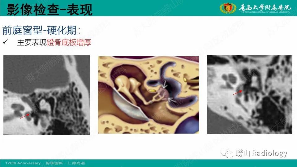 影像PPT - 【病例】耳硬化症1例CT影像-16