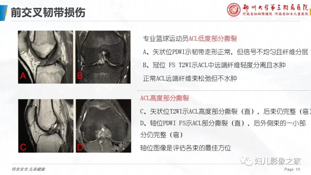 影像PPT - 【PPT】膝关节韧带病变的影像学表现-10
