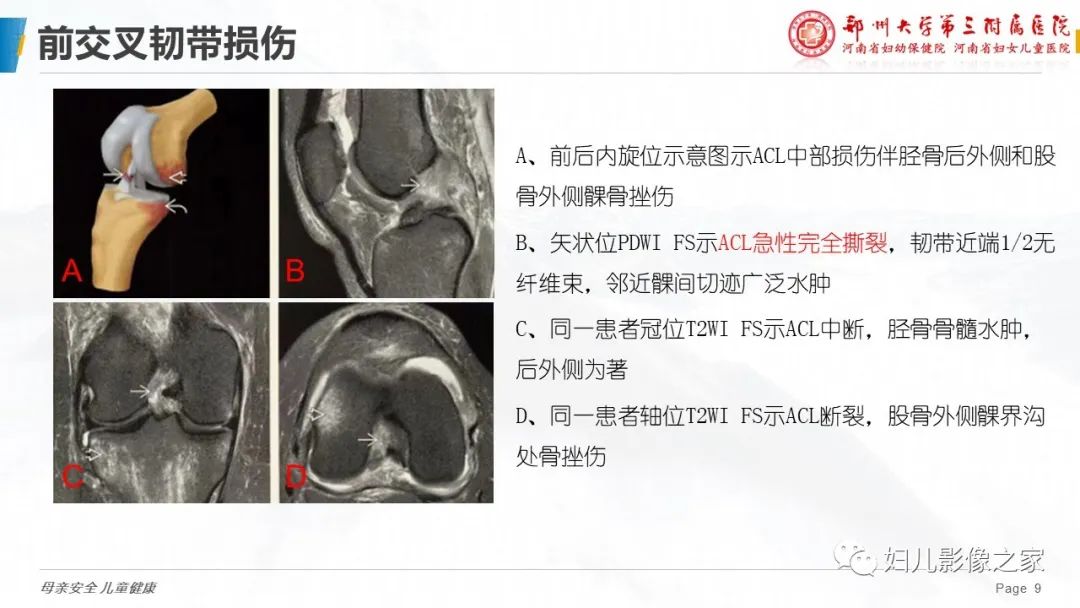影像PPT - 【PPT】膝关节韧带病变的影像学表现-9