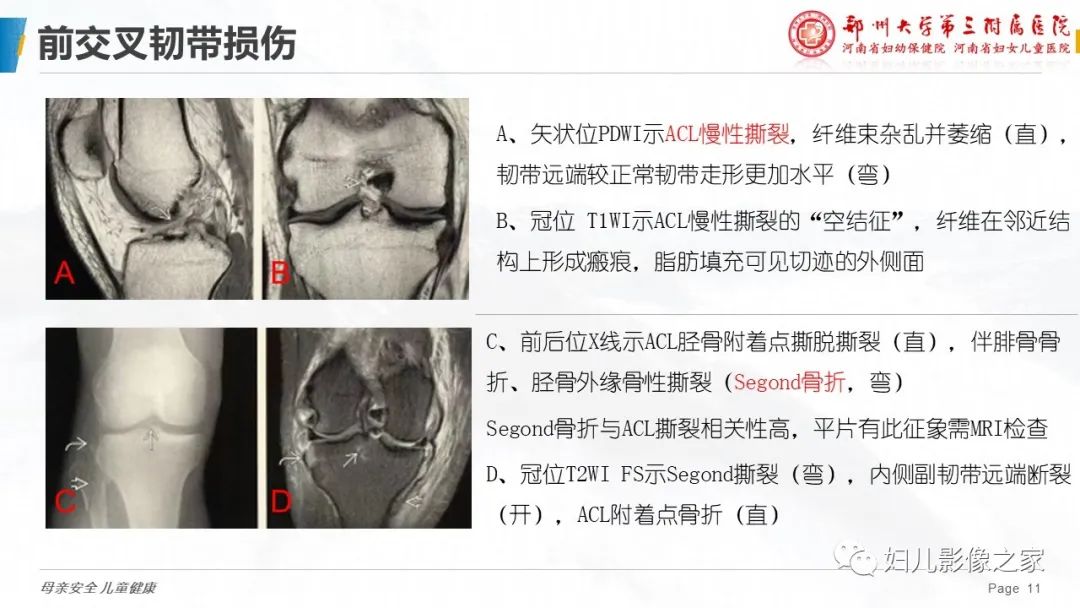 影像PPT - 【PPT】膝关节韧带病变的影像学表现-11
