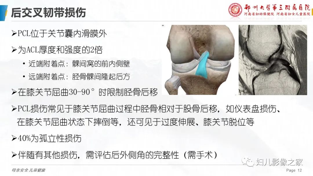 影像PPT - 【PPT】膝关节韧带病变的影像学表现-12