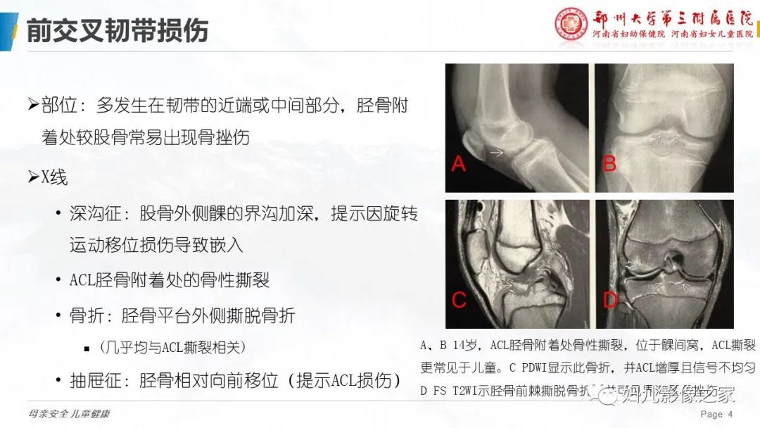 影像PPT - 【PPT】膝关节韧带病变的影像学表现-4