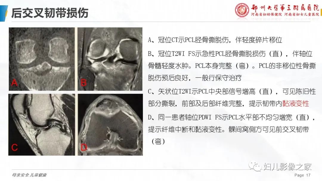 影像PPT - 【PPT】膝关节韧带病变的影像学表现-17