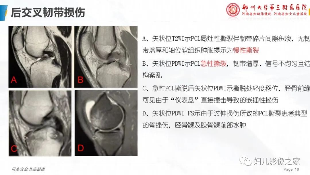 影像PPT - 【PPT】膝关节韧带病变的影像学表现-16
