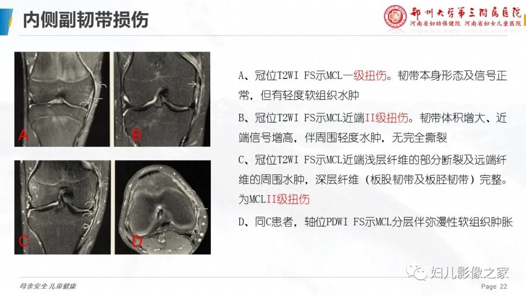 影像PPT - 【PPT】膝关节韧带病变的影像学表现-22