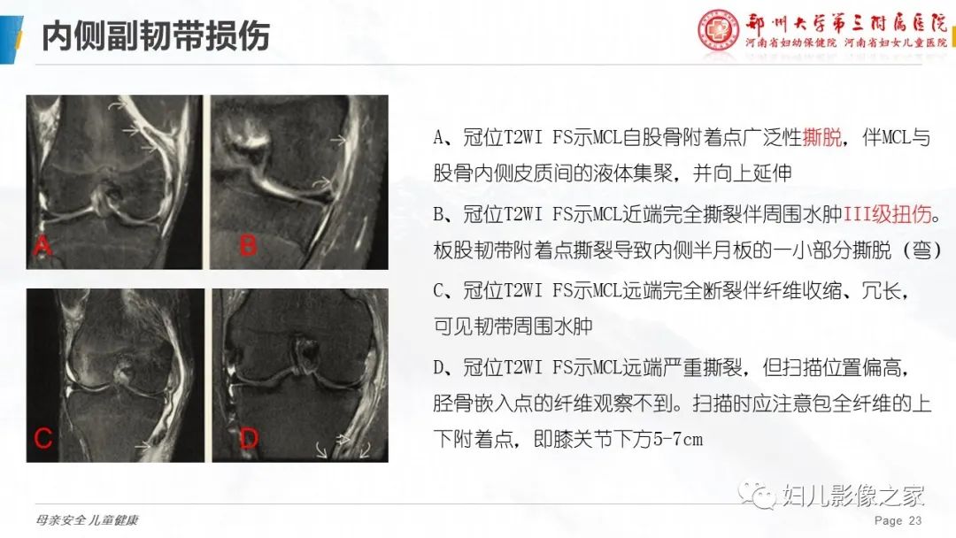 影像PPT - 【PPT】膝关节韧带病变的影像学表现-23