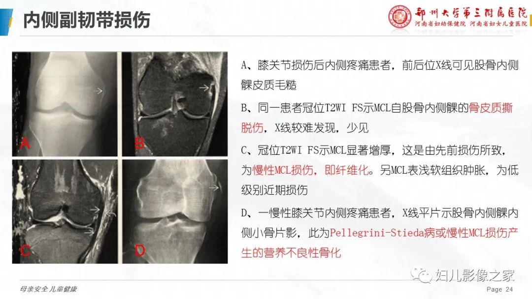 影像PPT - 【PPT】膝关节韧带病变的影像学表现-24