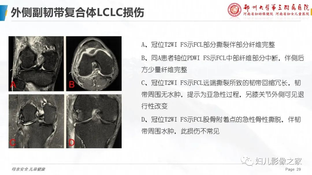 影像PPT - 【PPT】膝关节韧带病变的影像学表现-29