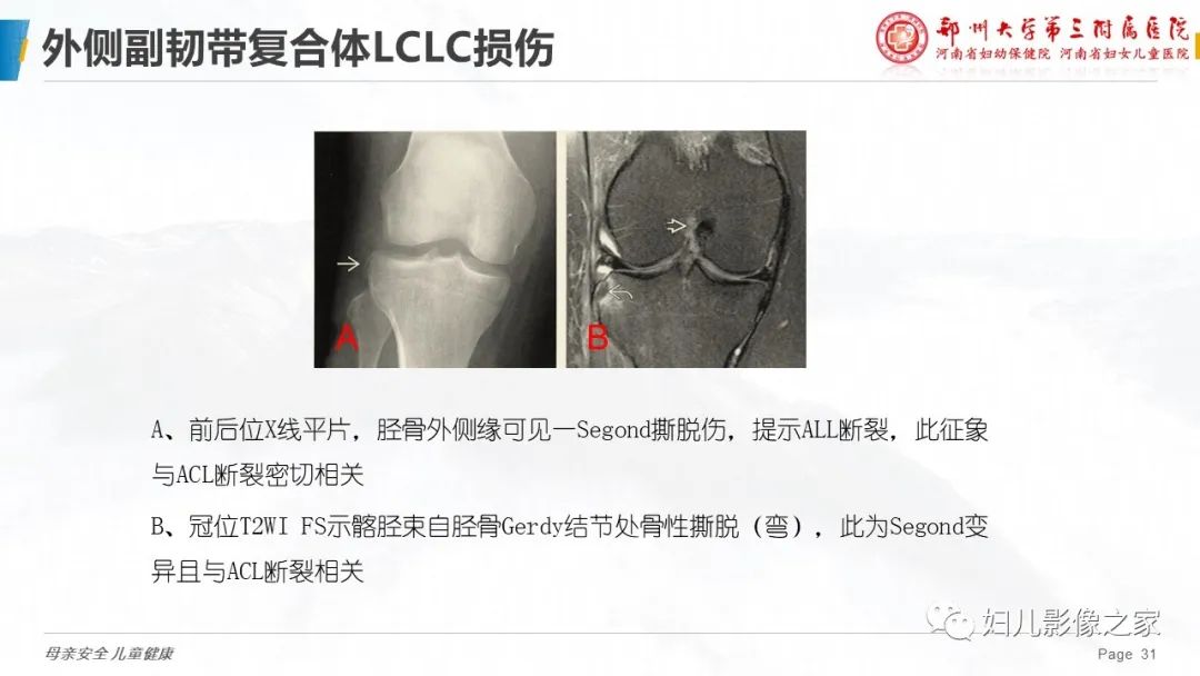 影像PPT - 【PPT】膝关节韧带病变的影像学表现-31