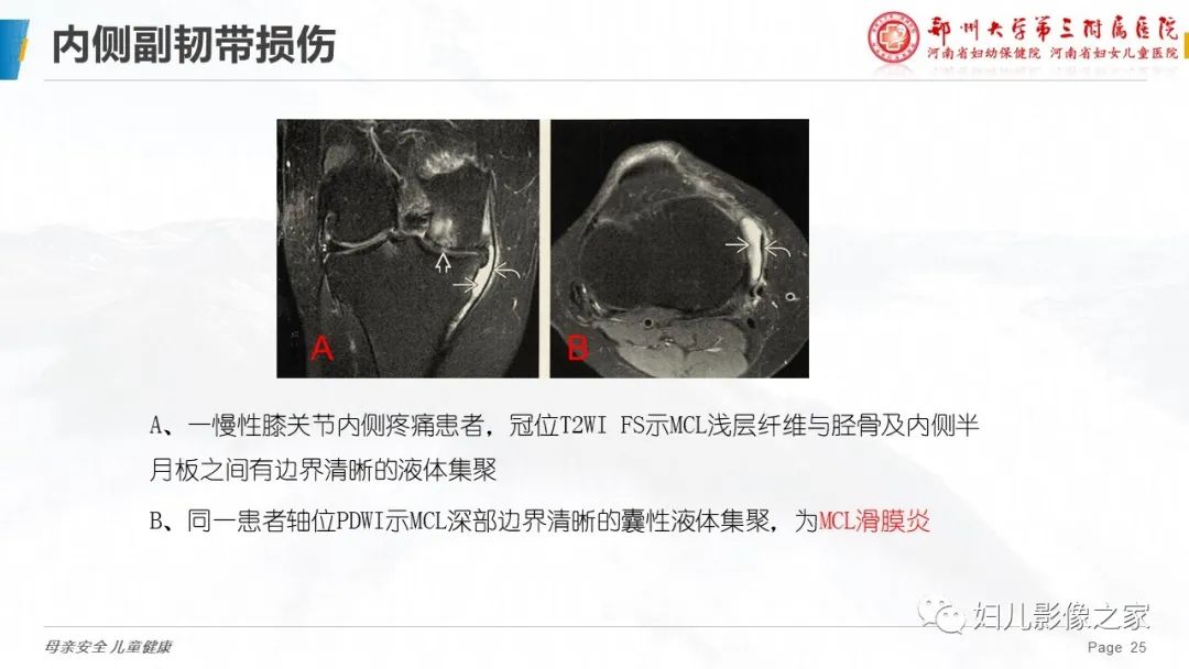 影像PPT - 【PPT】膝关节韧带病变的影像学表现-25