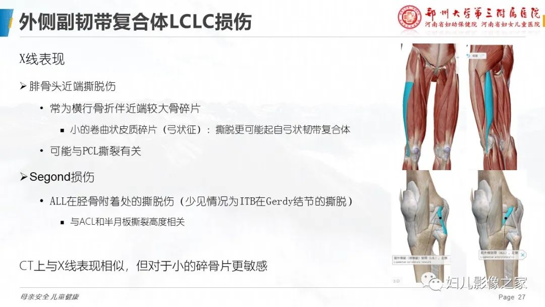 影像PPT - 【PPT】膝关节韧带病变的影像学表现-27