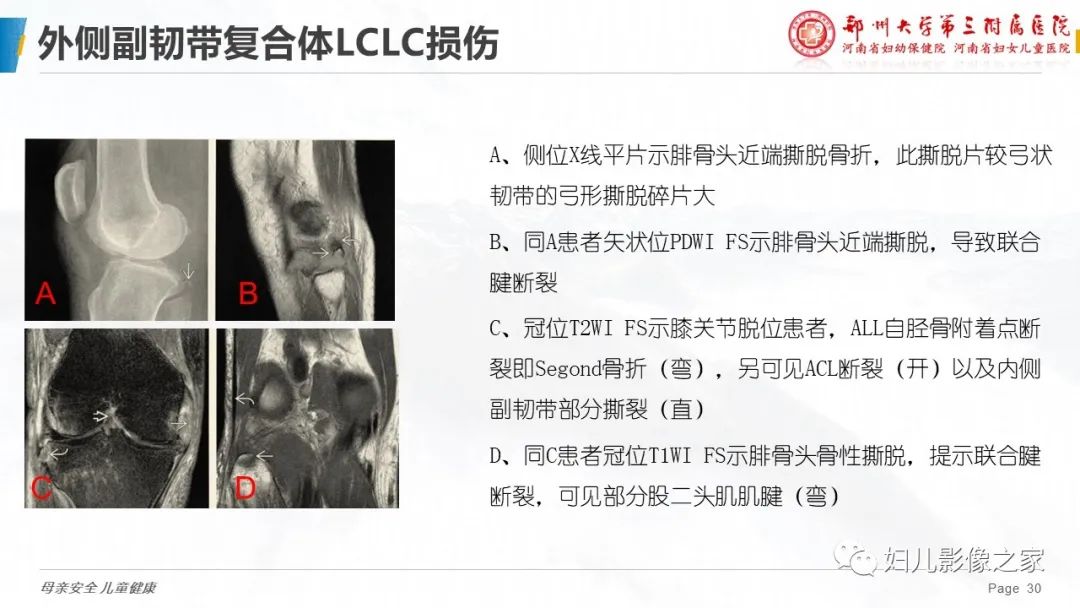 影像PPT - 【PPT】膝关节韧带病变的影像学表现-30