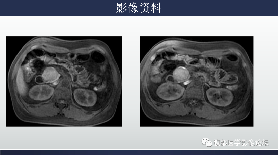 影像PPT - 【病例】胰腺实性假乳头状瘤1例MR影像-6