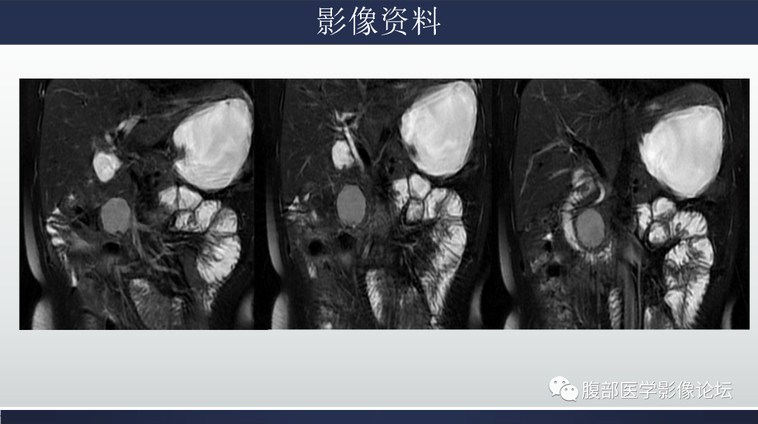 影像PPT - 【病例】胰腺实性假乳头状瘤1例MR影像-3