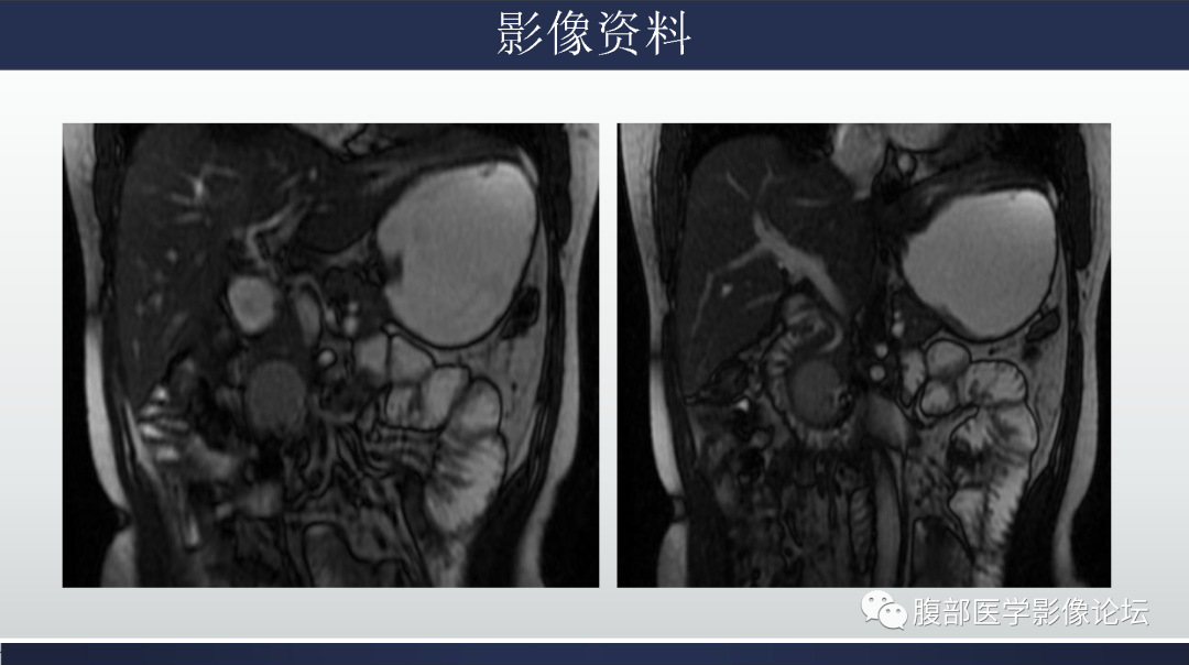 影像PPT - 【病例】胰腺实性假乳头状瘤1例MR影像-4