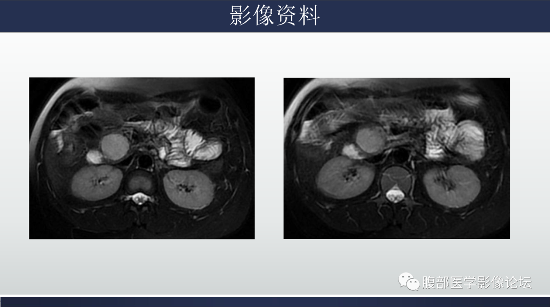 影像PPT - 【病例】胰腺实性假乳头状瘤1例MR影像-5
