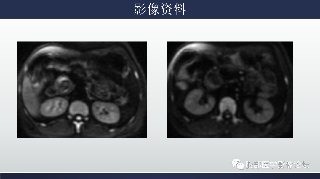 影像PPT - 【病例】胰腺实性假乳头状瘤1例MR影像-7