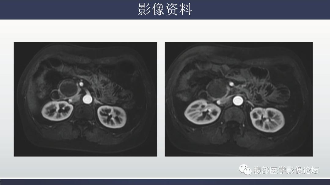 影像PPT - 【病例】胰腺实性假乳头状瘤1例MR影像-10