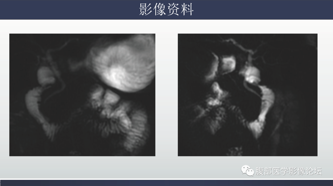 影像PPT - 【病例】胰腺实性假乳头状瘤1例MR影像-9