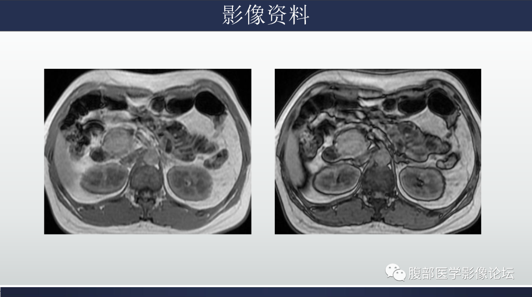 影像PPT - 【病例】胰腺实性假乳头状瘤1例MR影像-8
