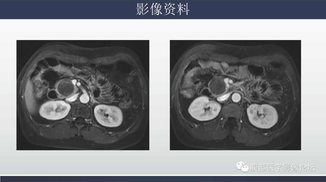 影像PPT - 【病例】胰腺实性假乳头状瘤1例MR影像-12