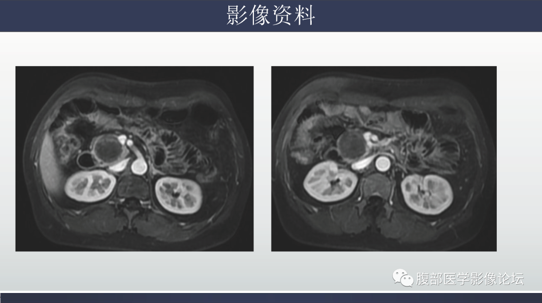 影像PPT - 【病例】胰腺实性假乳头状瘤1例MR影像-11
