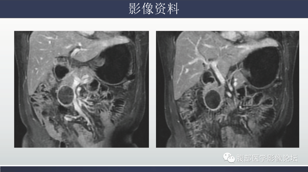 影像PPT - 【病例】胰腺实性假乳头状瘤1例MR影像-13