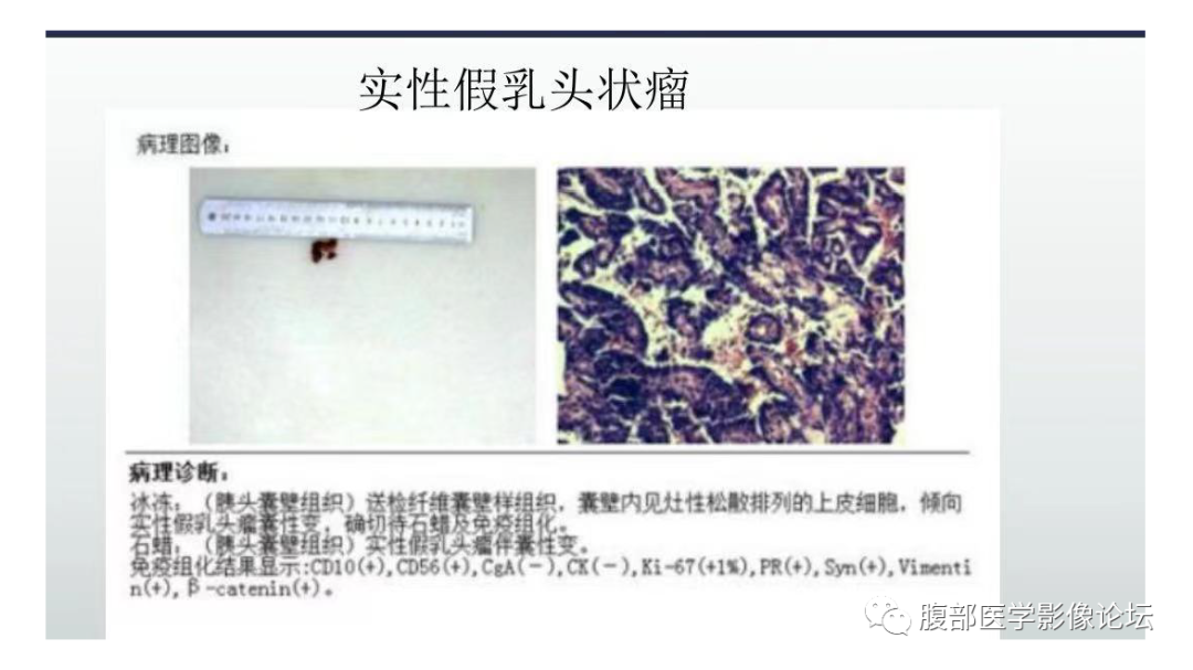 影像PPT - 【病例】胰腺实性假乳头状瘤1例MR影像-14