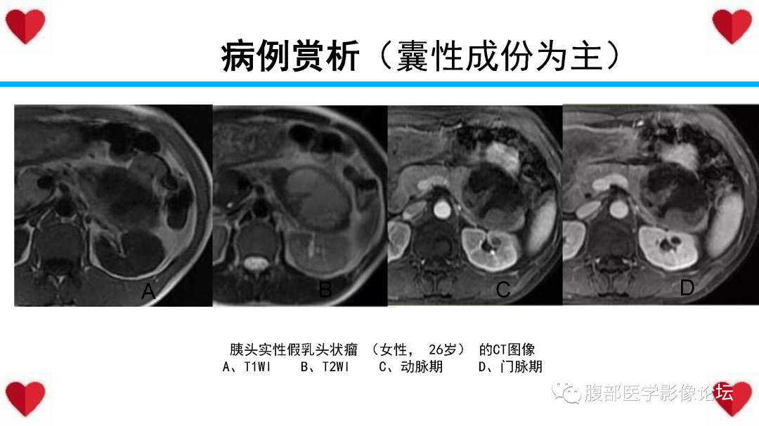 影像PPT - 【病例】胰腺实性假乳头状瘤1例MR影像-31