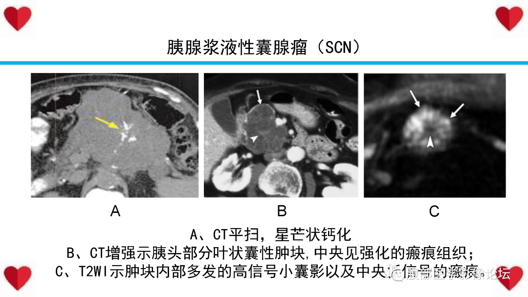 影像PPT - 【病例】胰腺实性假乳头状瘤1例MR影像-38