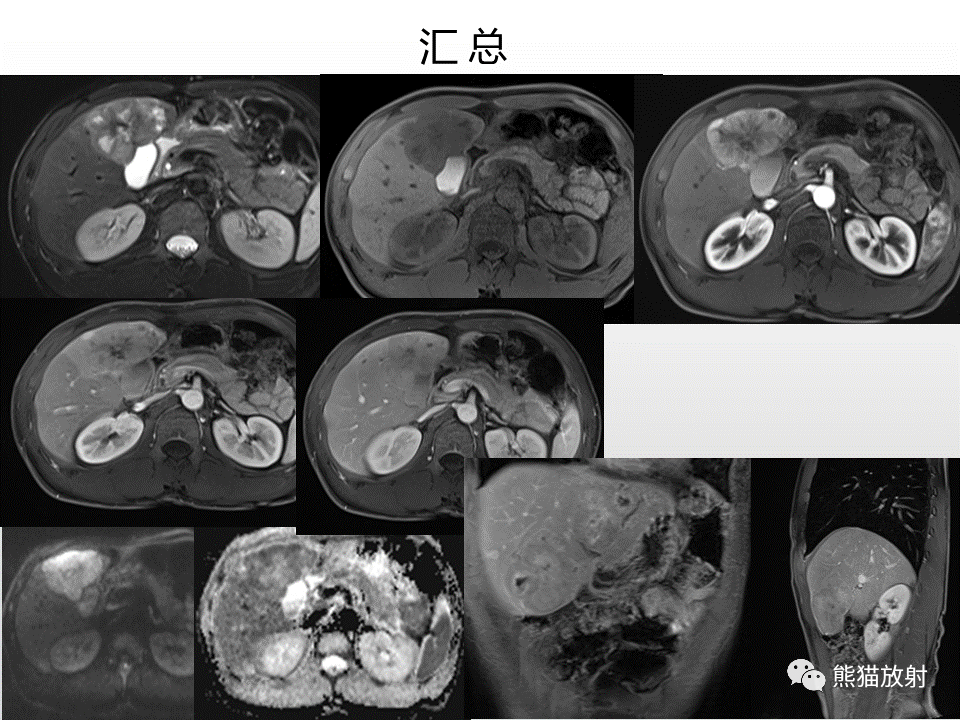 影像PPT - 【病例】肝脏多发神经内分泌癌1例MR及CT-12