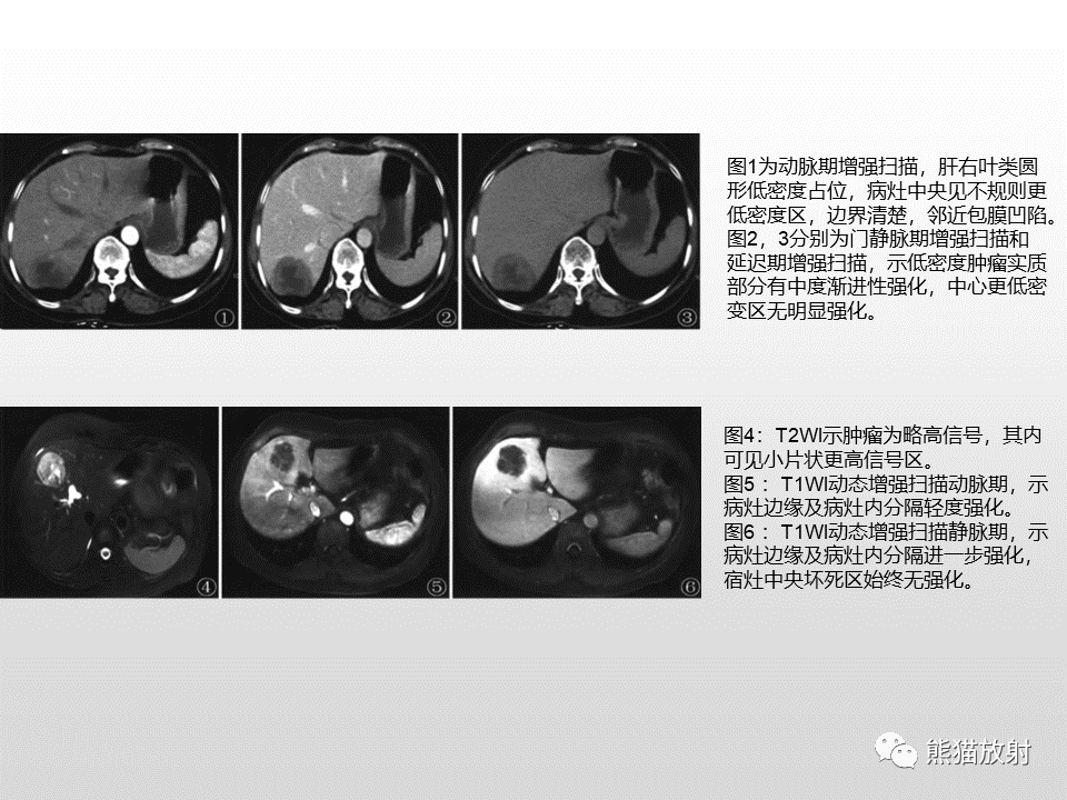 影像PPT - 【病例】肝脏多发神经内分泌癌1例MR及CT-20