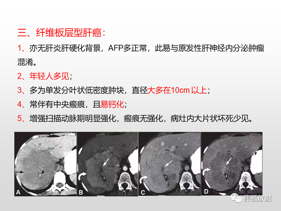 影像PPT - 【病例】肝脏多发神经内分泌癌1例MR及CT-24