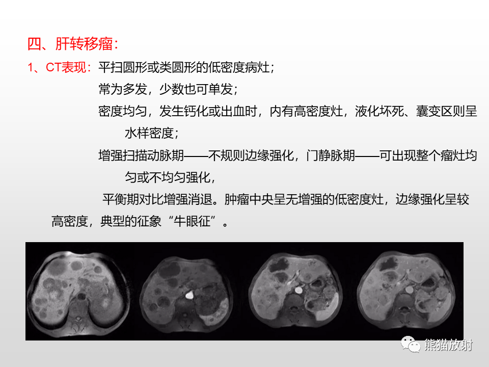 影像PPT - 【病例】肝脏多发神经内分泌癌1例MR及CT-25