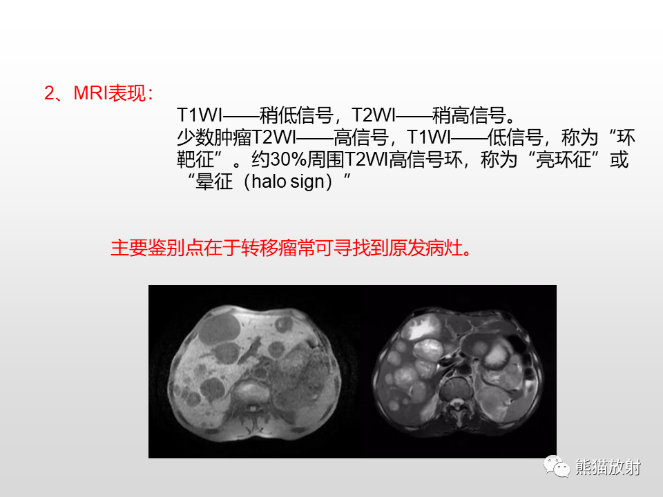 影像PPT - 【病例】肝脏多发神经内分泌癌1例MR及CT-26