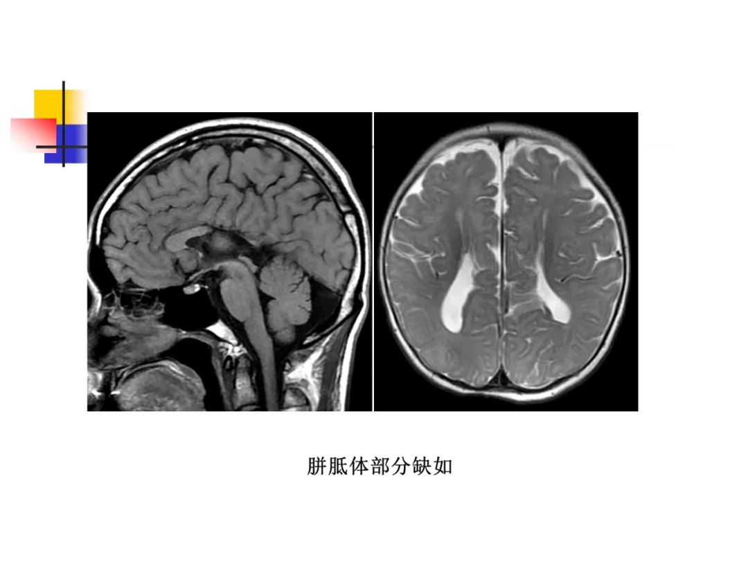 影像PPT - 【PPT】先天畸形、变性及椎管疾病-6