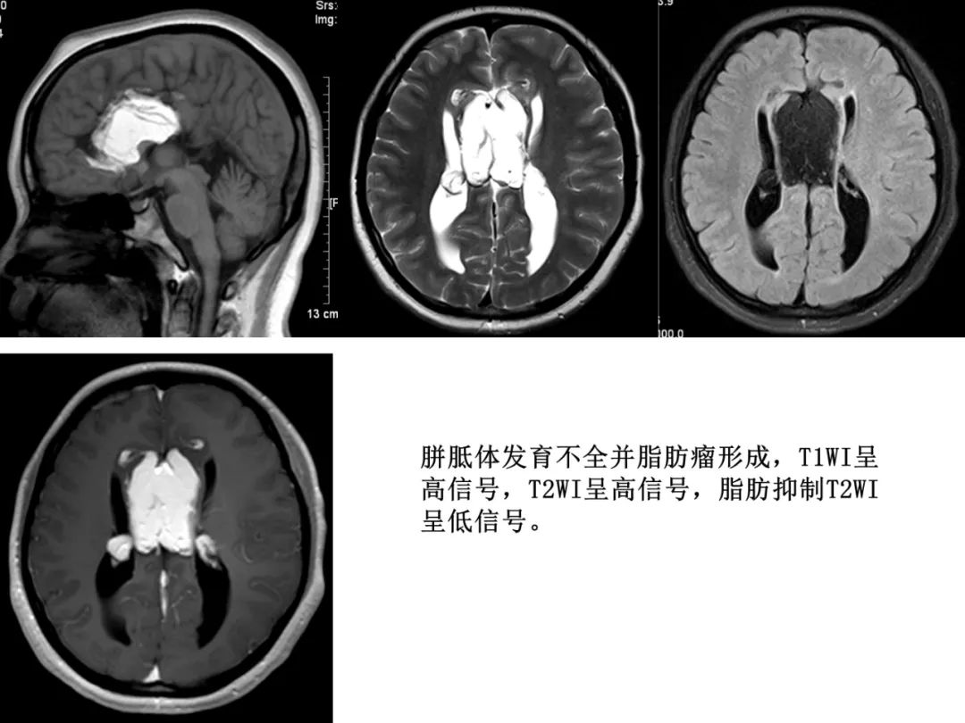 影像PPT - 【PPT】先天畸形、变性及椎管疾病-9