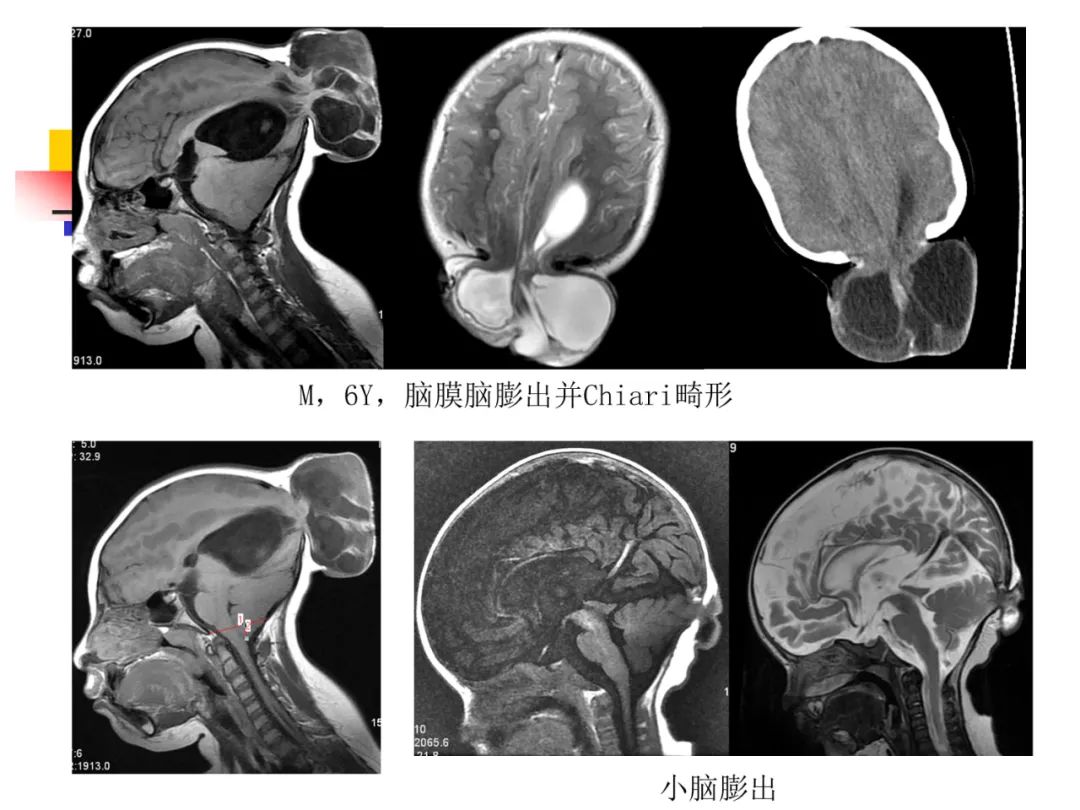 影像PPT - 【PPT】先天畸形、变性及椎管疾病-11