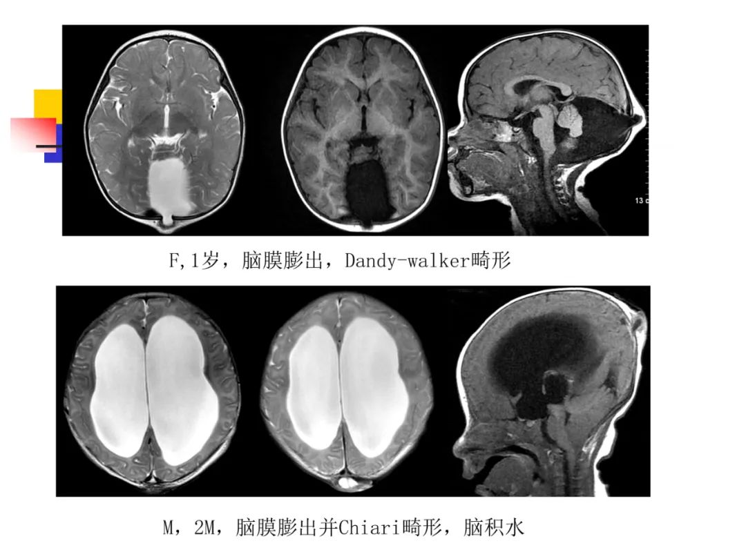 影像PPT - 【PPT】先天畸形、变性及椎管疾病-12