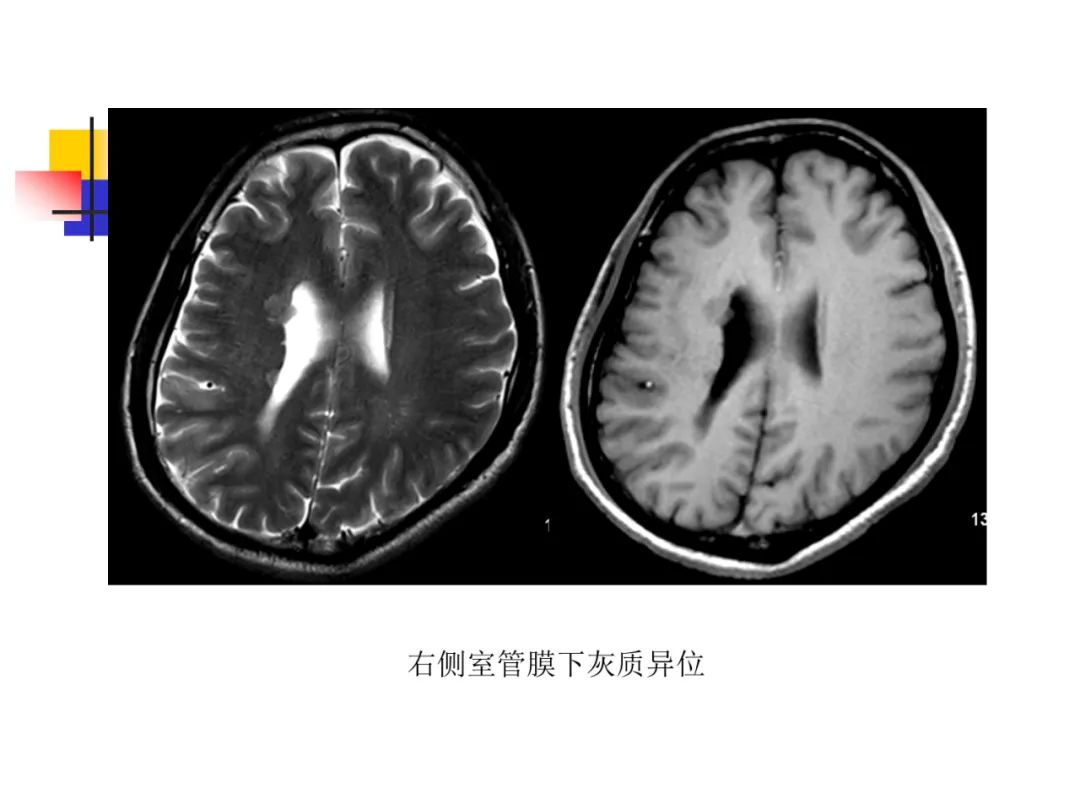 影像PPT - 【PPT】先天畸形、变性及椎管疾病-19