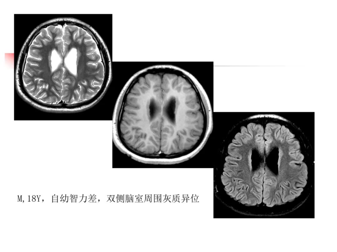 影像PPT - 【PPT】先天畸形、变性及椎管疾病-20