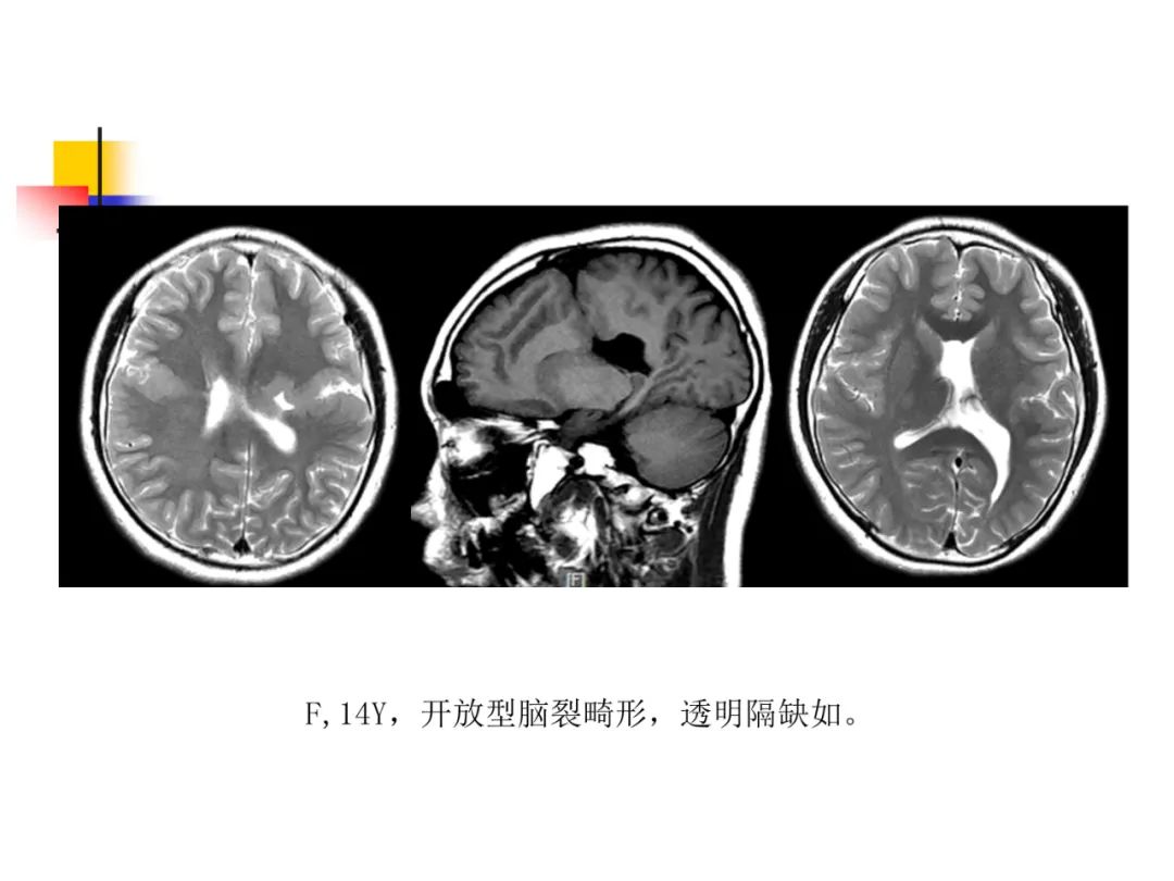 影像PPT - 【PPT】先天畸形、变性及椎管疾病-22