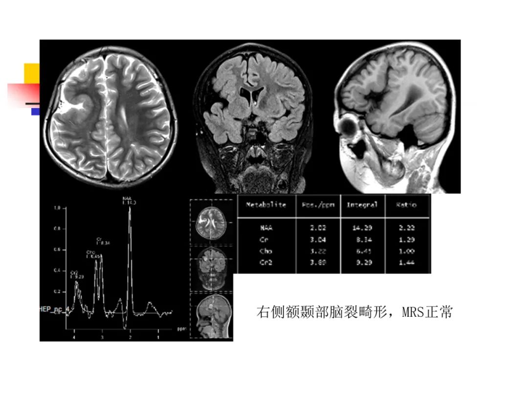 影像PPT - 【PPT】先天畸形、变性及椎管疾病-23